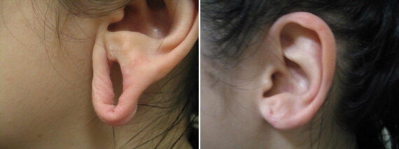 Before and after Ear Gauge Repair by Dr. David W. Allison, Patient 1557