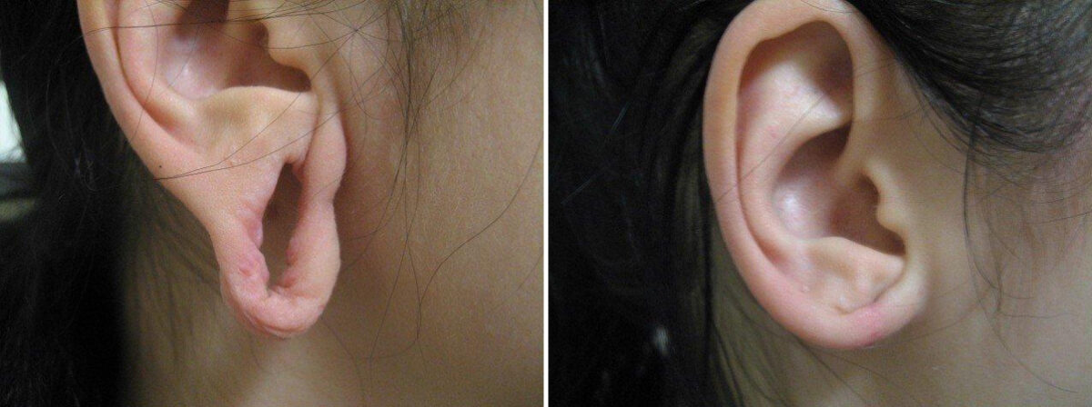 Before and after Ear Gauge Repair by Dr. David W. Allison, Patient 1557