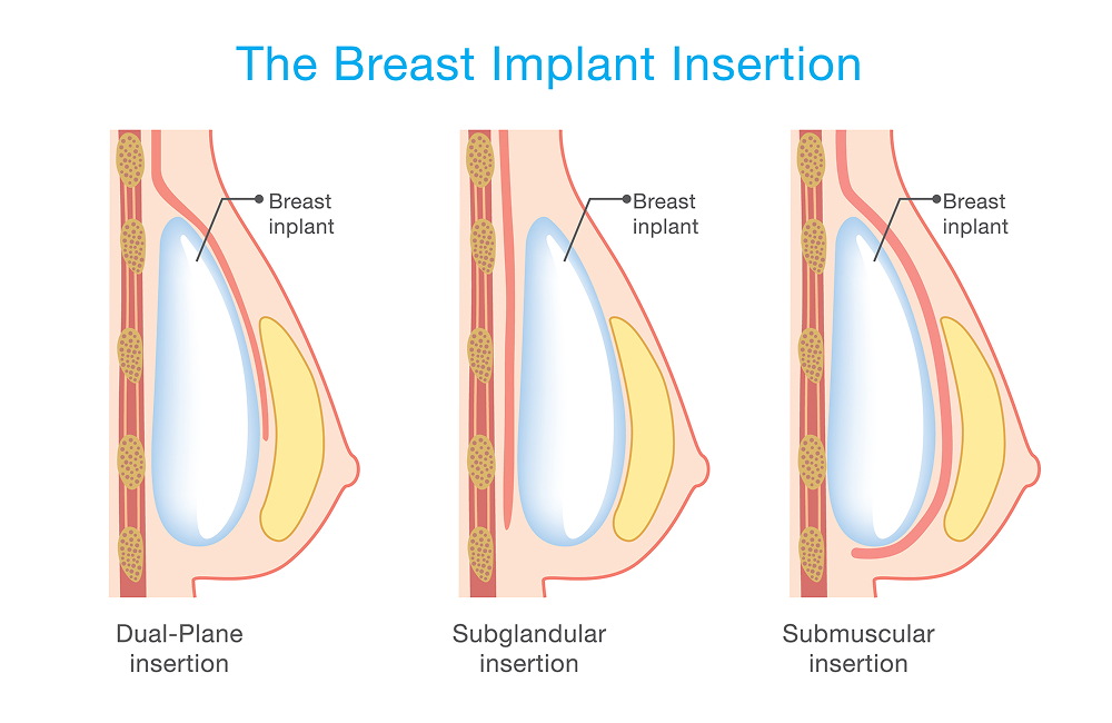 Diagram showing dual-plane, subglandular, and submuscular breast implant insertion techniques with labeled anatomy.