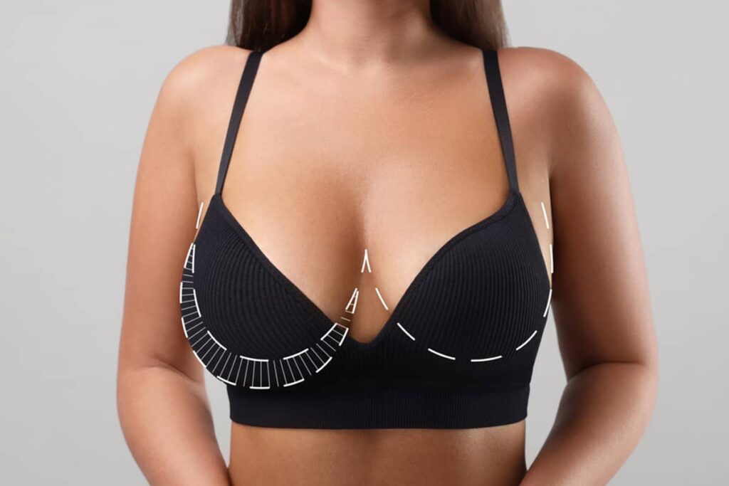 A woman’s torso in a black ribbed bra, featuring white dashed and solid line patterns that indicate potential surgical incision sites and contour points.