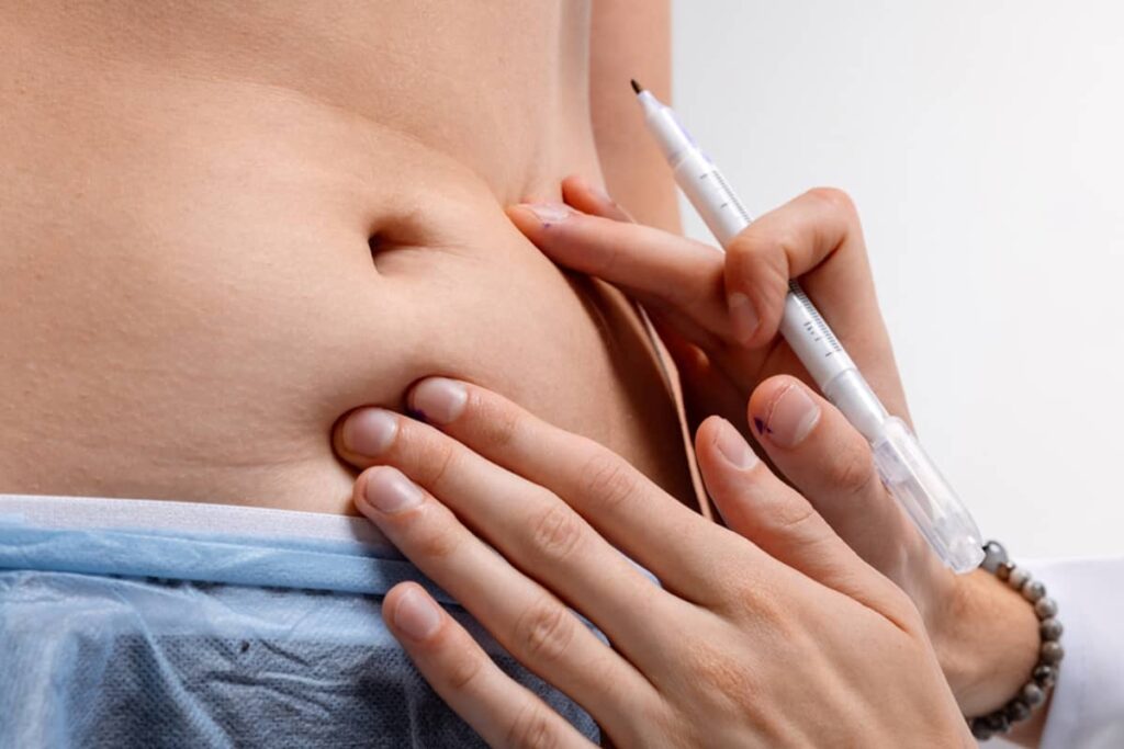 A close-up of a surgeon’s hands using a surgical marker to map out treatment areas on a patient's abdomen for a liposuction procedure.