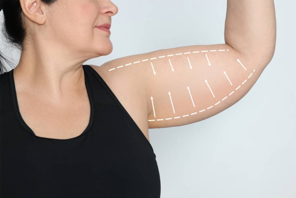 A side profile view of a woman in a black tank top holding her arm up, featuring white dashed surgical lines and arrows mapped across the loose skin of her upper arm.