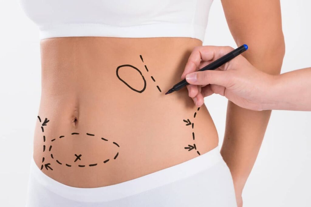 A medical professional using a black marker to map out surgical entry points and treatment zones on a patient's abdomen.
