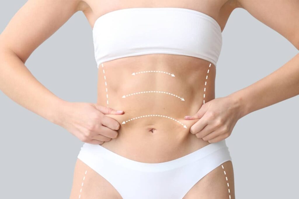 Woman’s abdomen with marked areas indicating post-pregnancy body contouring and abdominal skin tightening procedures
