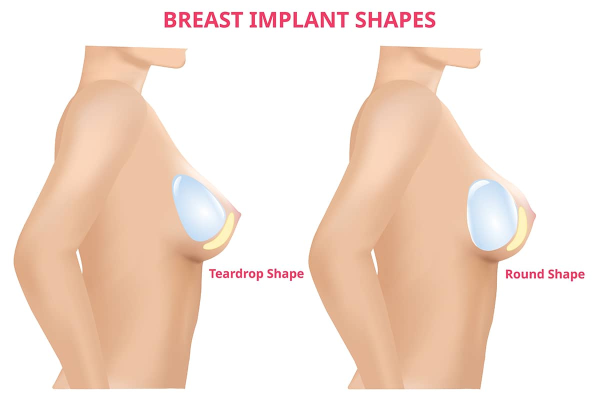 A side-view medical illustration comparing "Teardrop Shape" implants, which are fuller at the bottom, and "Round Shape" implants, which provide uniform fullness.