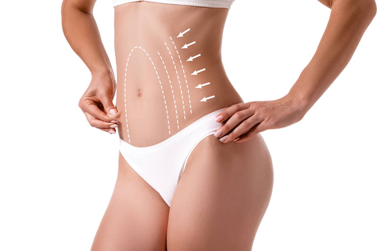 A side view of a woman in white undergarments pinching a small amount of skin on her abdomen, with white dashed lines and arrows indicating surgical contouring areas.