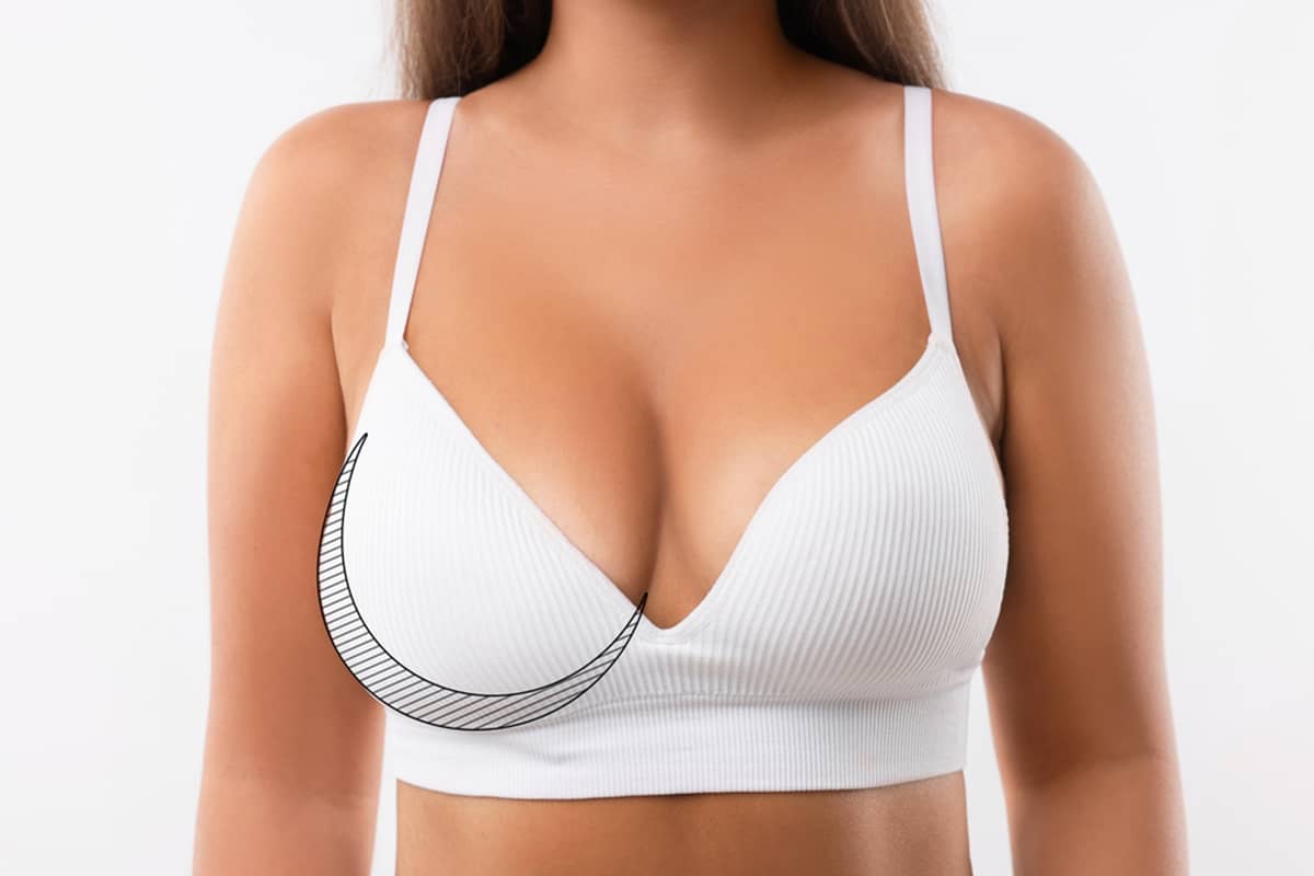 A woman in a white ribbed bra with a black crescent-shaped surgical marking under one breast to indicate a planned lift or contour adjustment.