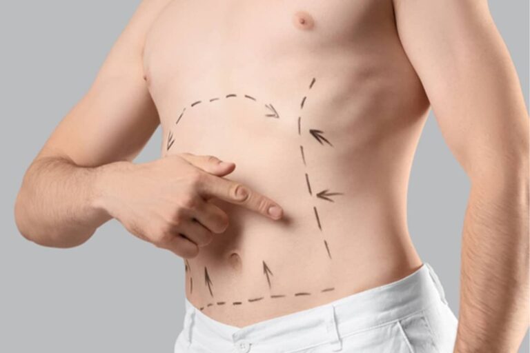 A close-up of a man's midsection with black surgical dashed lines and arrows indicating planned liposuction zones on the stomach.