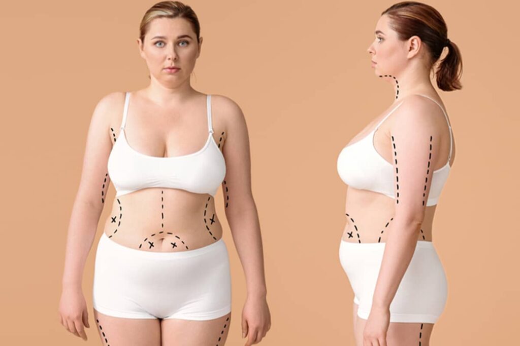 A front and profile view of a woman in white undergarments with surgical markings on her neck, arms, waist, and legs.