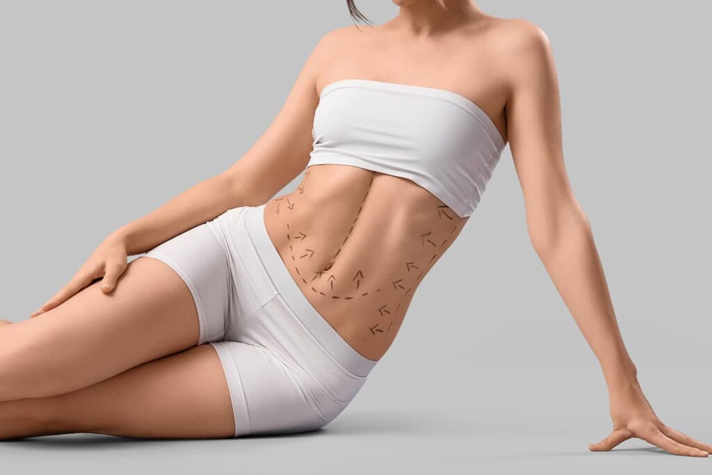 A woman with markings on her abdomen indicating future incisions and fat removal points is lying down in white undergarments against a grey background.