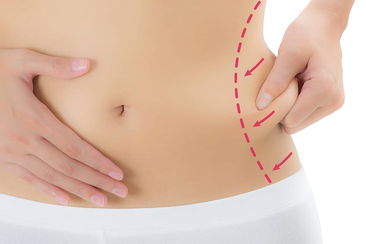 Close-up view of a woman’s abdomen showing her pinching excess fat tissue on her side, which has white dotted lines and pink arrows overlaid to mark the treatment area.