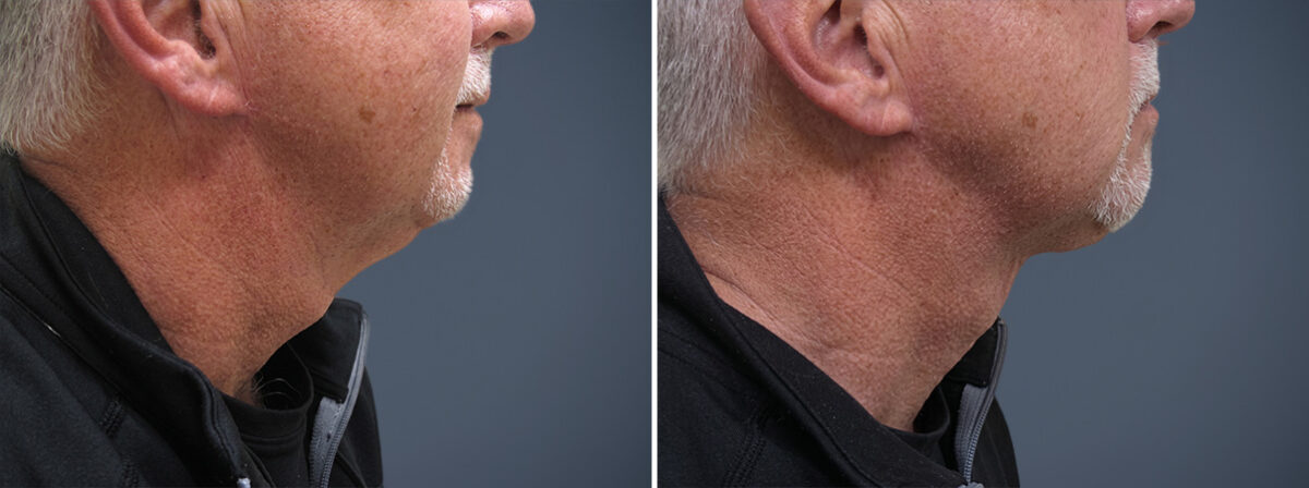 Before and after Neck Lift by Dr. David W. Allison, Patient 1447