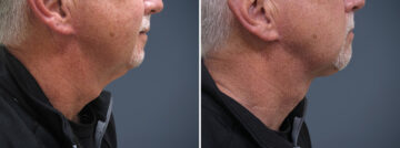 Before and after Neck Lift by Dr. David W. Allison, Patient 1447