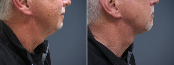 Neck Lift before and after photos in Princeton, NJNeck Lift Before and After Photos in Princeton, NJ