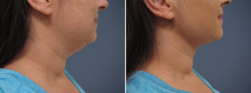 Before and after Neck Lift by Dr. David W. Allison, Patient 1451