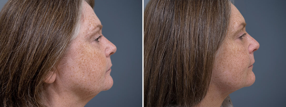 Before and after Face and Neck by Dr. David W. Allison, Patient 1455