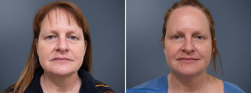 Before and after Face and Neck by Dr. David W. Allison, Patient 1459
