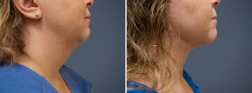 Before and after Face and Neck by Dr. David W. Allison, Patient 1463