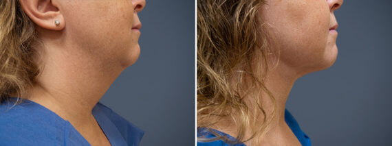 Face and Neck before and after photos in Princeton, NJFace and Neck Before and After Photos in Princeton, NJ