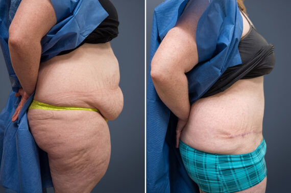 Before and after Tummy Tuck by Dr. David W. Allison, Patient 1467