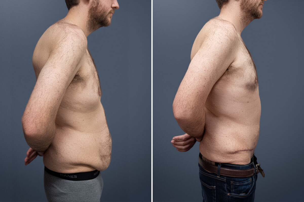 Before and after Tummy Tuck by Dr. David W. Allison, Patient 1471