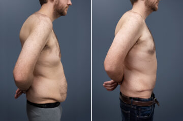 Before and after Tummy Tuck by Dr. David W. Allison, Patient 1471