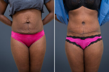 Before and after Tummy Tuck by Dr. David W. Allison, Patient 1475