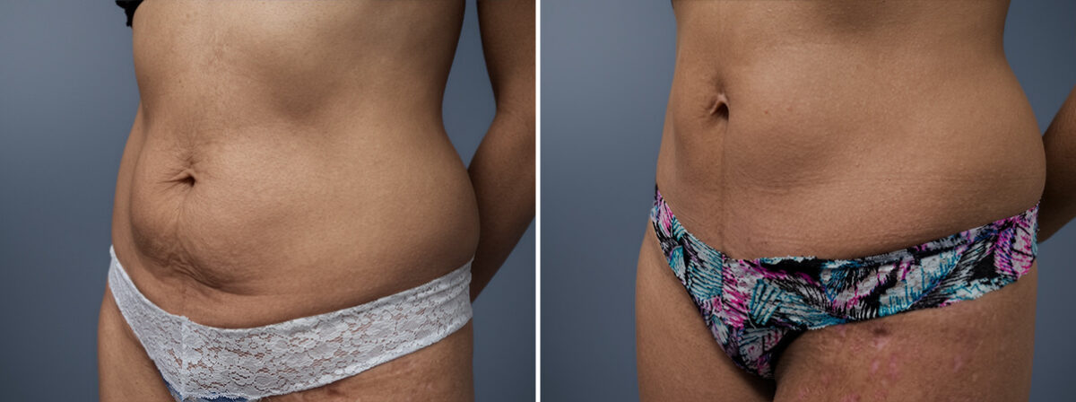 Before and after Mini Tummy Tuck by Dr. David W. Allison, Patient 1479