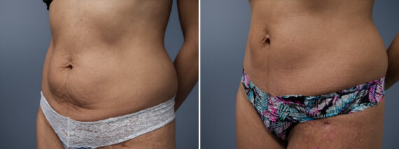 Before and after Mini Tummy Tuck by Dr. David W. Allison, Patient 1479