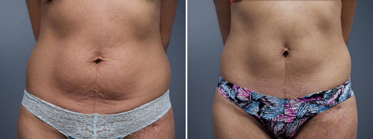 Before and after Mini Tummy Tuck by Dr. David W. Allison, Patient 1479