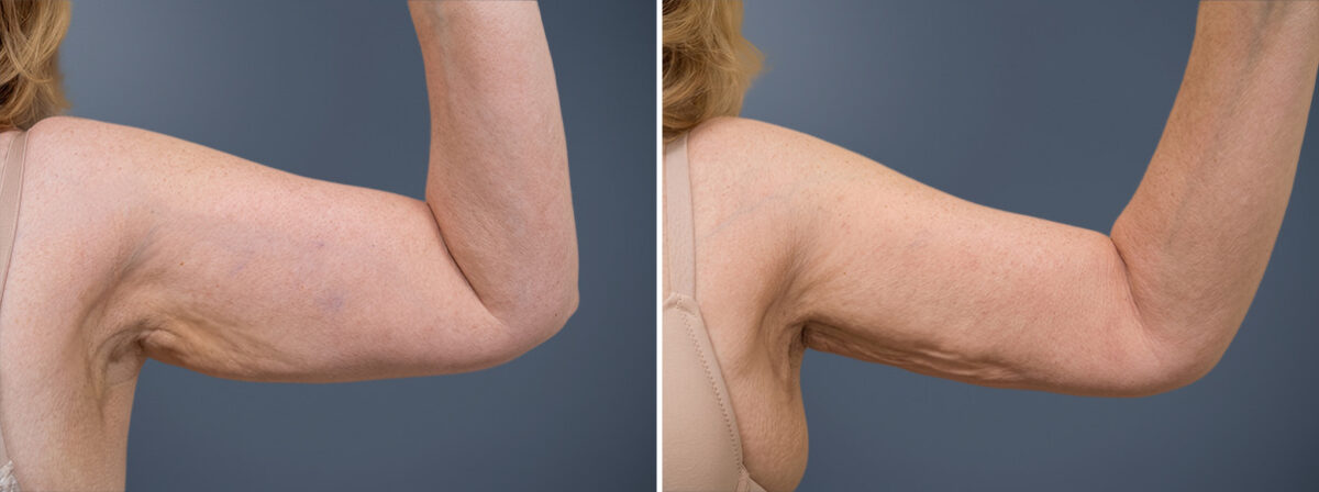 Before and after Arm Liposuction by Dr. David W. Allison, Patient 1486