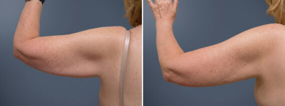 Arm Liposuction before and after photos in Princeton, NJArm Liposuction Before and After Photos in Princeton, NJ