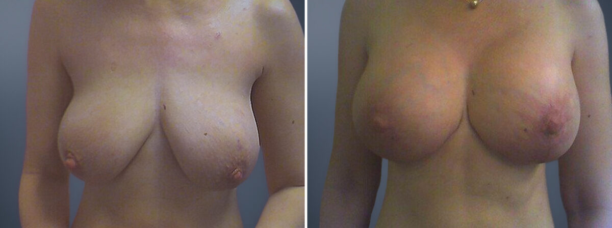 Before and after Breast Augmentation by Dr. David W. Allison, Patient 1493
