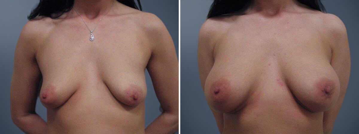 Before and after Breast Augmentation by Dr. David W. Allison, Patient 1497