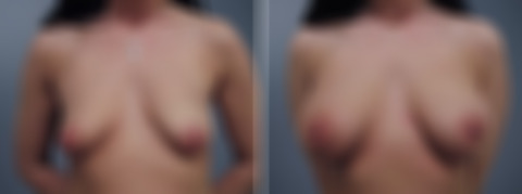 Before and after Breast Augmentation by Dr. David W. Allison, Patient 1497