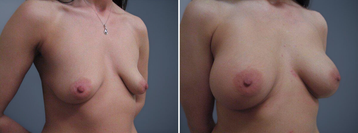 Before and after Breast Augmentation by Dr. David W. Allison, Patient 1497
