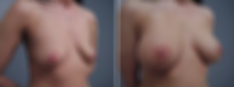 Before and after Breast Augmentation by Dr. David W. Allison, Patient 1497