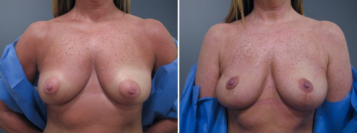Before and after Breast Augmentation by Dr. David W. Allison, Patient 1519