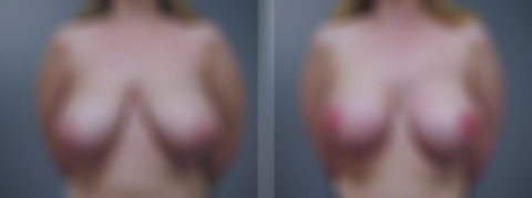 Before and after Breast Augmentation by Dr. David W. Allison, Patient 1523