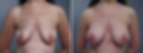 Before and after Breast Augmentation by Dr. David W. Allison, Patient 1527