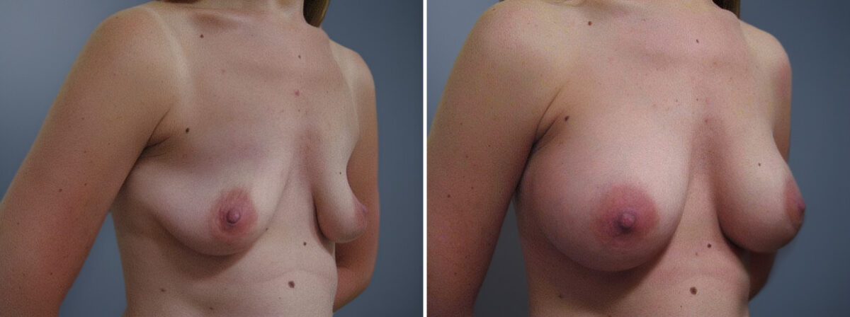 Before and after Breast Augmentation by Dr. David W. Allison, Patient 1527