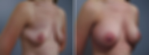 Before and after Breast Augmentation by Dr. David W. Allison, Patient 1527