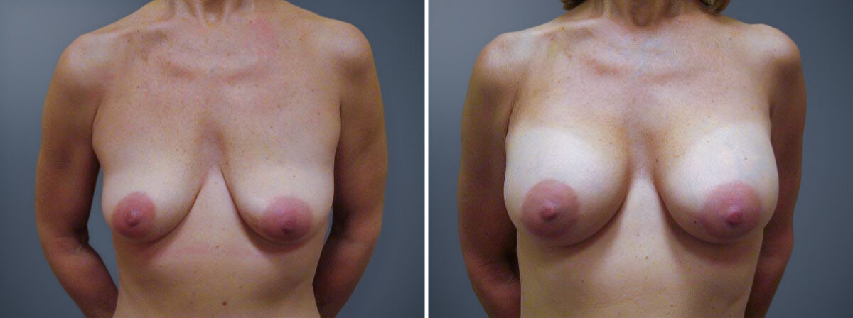Before and after Breast Augmentation by Dr. David W. Allison, Patient 1534