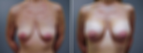 Before and after Breast Augmentation by Dr. David W. Allison, Patient 1534