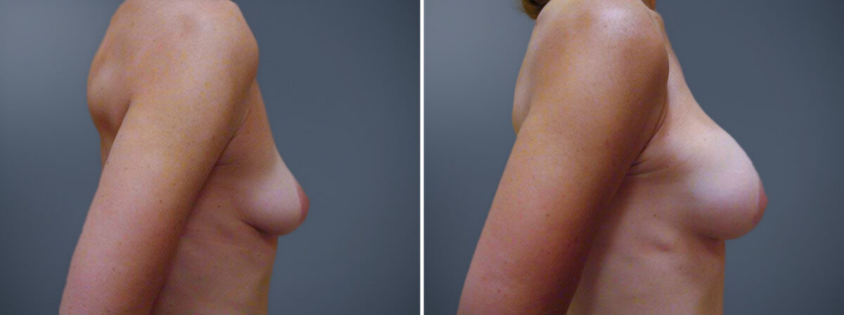 Before and after Breast Augmentation by Dr. David W. Allison, Patient 1534