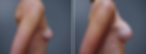 Before and after Breast Augmentation by Dr. David W. Allison, Patient 1534