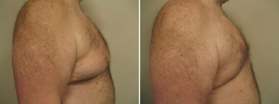 Before and after Gynecomastia Reduction by Dr. David W. Allison, Patient 1541