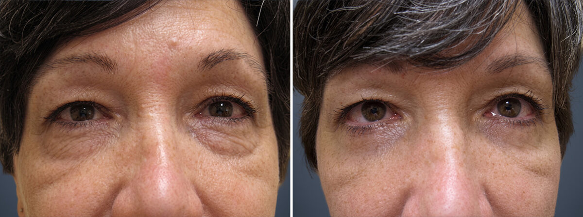 Before and after Eyelid Surgery by Dr. David W. Allison, Patient 1545
