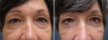 Before and after Eyelid Surgery by Dr. David W. Allison, Patient 1545