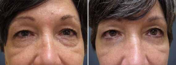 Eyelid Surgery before and after photos in Princeton, NJEyelid Surgery Before and After Photos in Princeton, NJ